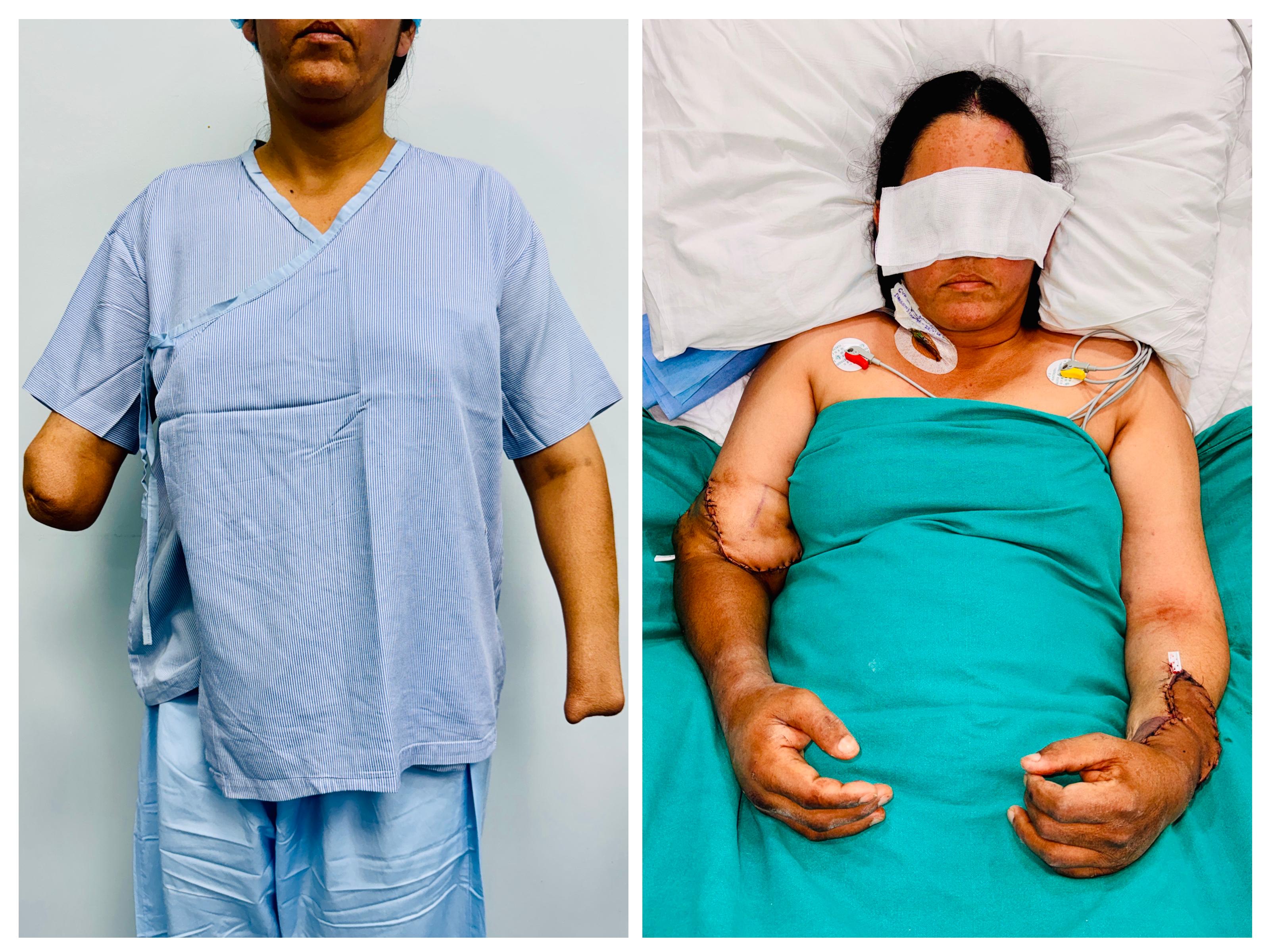 2nd bilateral hand transplant