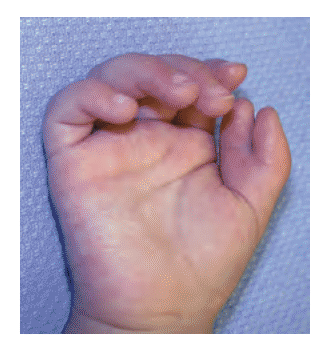 When a Childs Hand Develops Differently: What Parents Should Watch For When a Childs Hand Develops Differently: What Parents Should Watch For